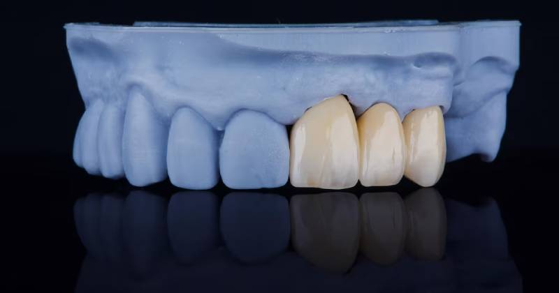 مشکلات رایج و دلایل کاهش ماندگاری بریج دندان