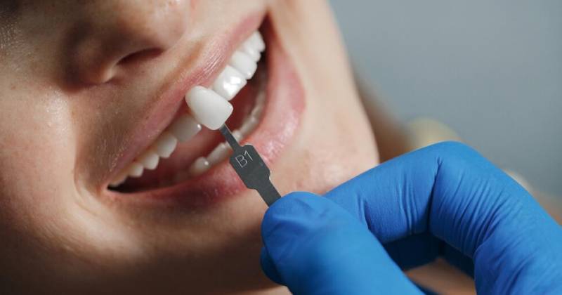 مراحل کار بریج دندان