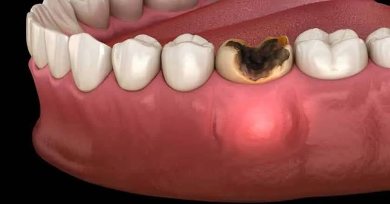 علت سیاه شدن دندان از داخل