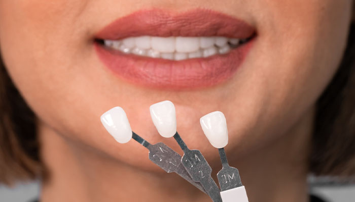 لمینت دندان چیست