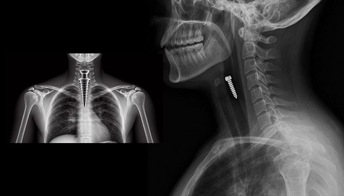 قورت دادن ایمپلنت