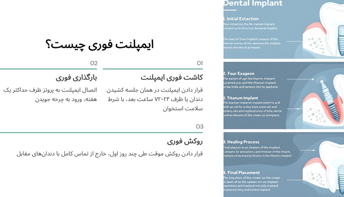ایمپلنت فوری چیست؟