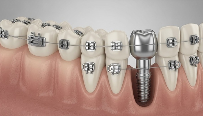 ایمپلنت حین ارتودنسی